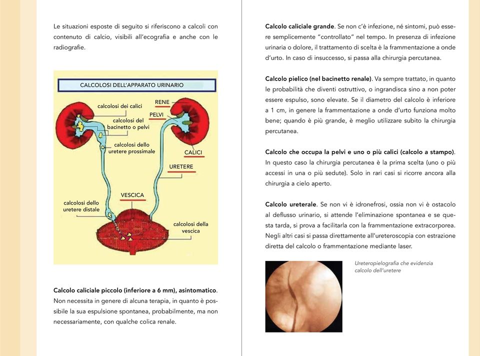 In caso di insuccesso, si passa alla chirurgia percutanea. Calcolosi dell apparato urinario RENE calcolosi dei calici PELVI calcolosi del bacinetto o pelvi Calcolo pielico (nel bacinetto renale).