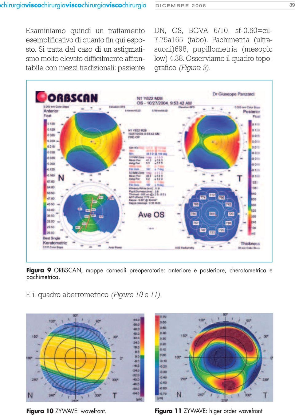 75a165 (tabo). Pachimetria (ultrasuoni)698, pupillometria (mesopic low) 4.38. Osserviamo il quadro topografico (Figura 9).