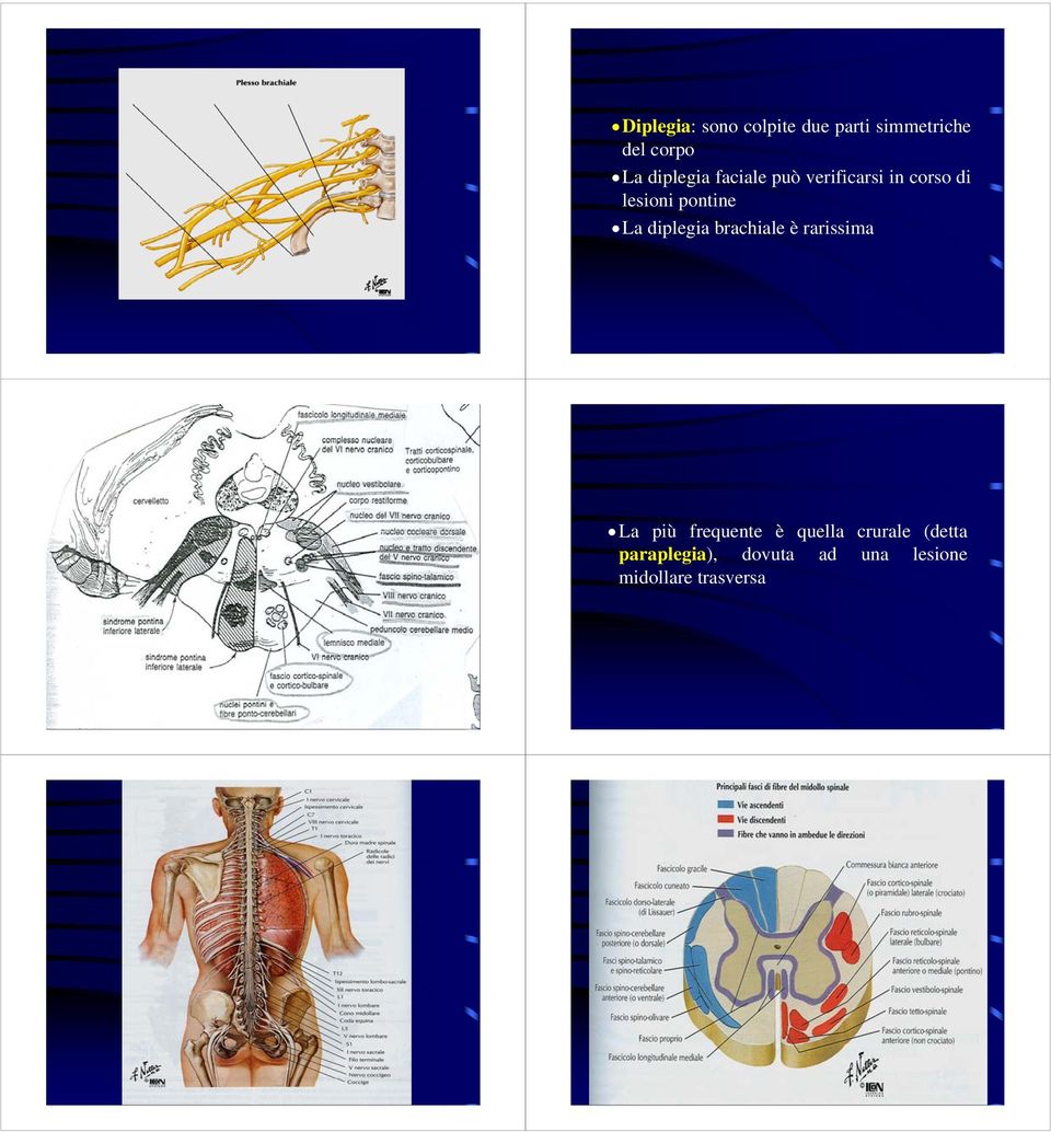 La diplegia brachiale è rarissima La più frequente è quella