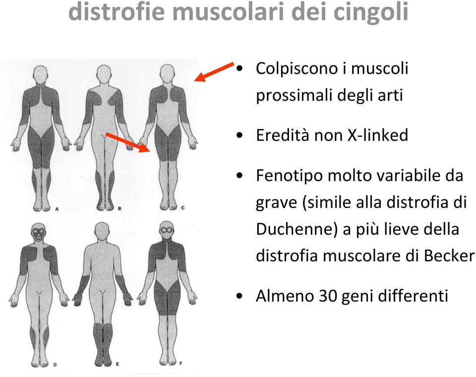 variabile da grave (simile alla distrofia di Duchenne) a