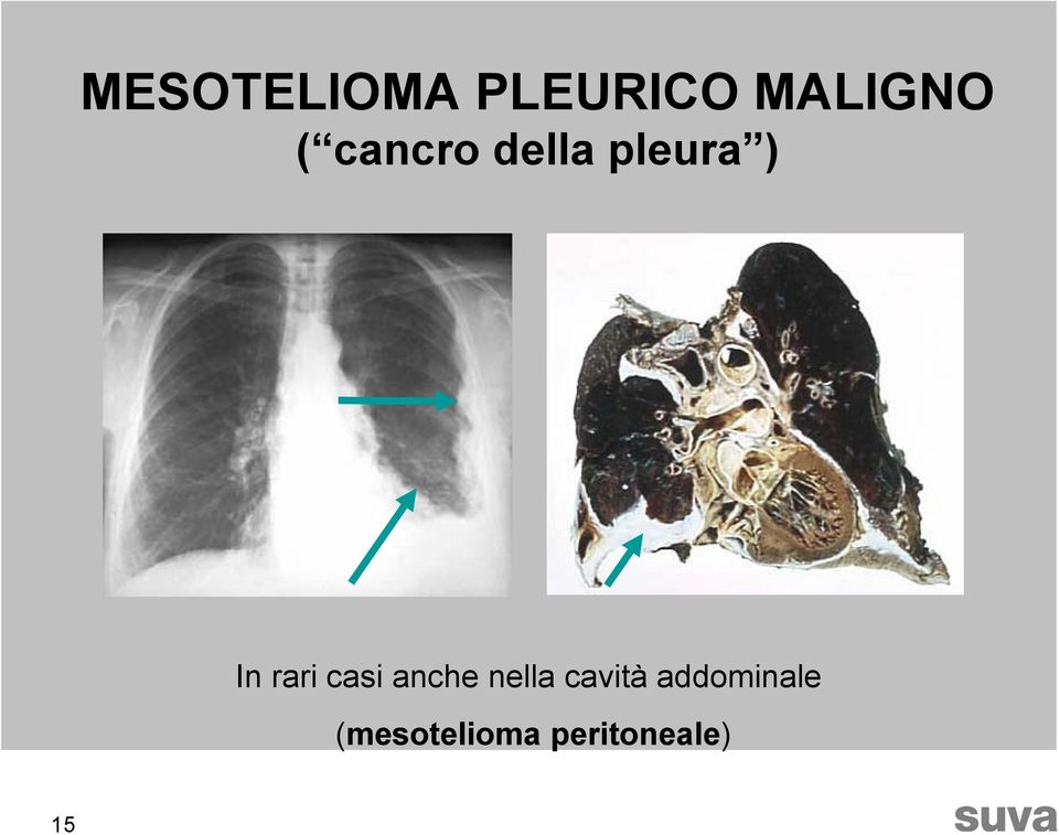 casi anche nella cavità