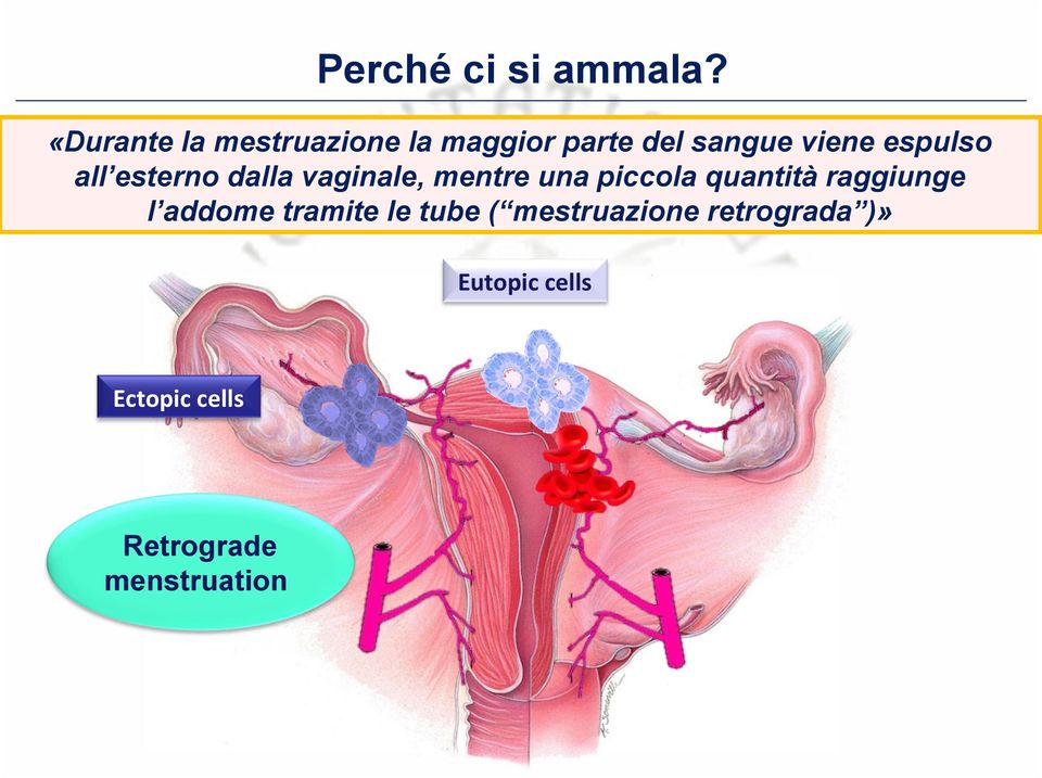 espulso all esterno dalla vaginale, mentre una piccola quantità