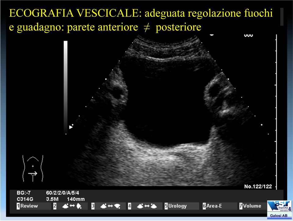 Bladder volume may be calculated from measurements of length, width and height of the bladder.