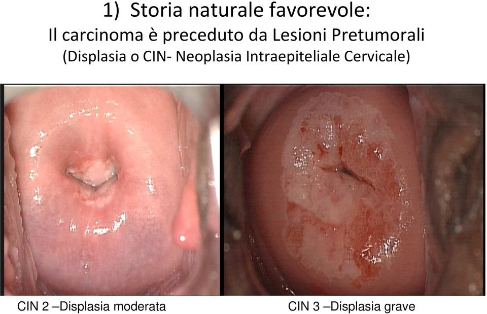 o CIN- Neoplasia Intraepiteliale Cervicale)