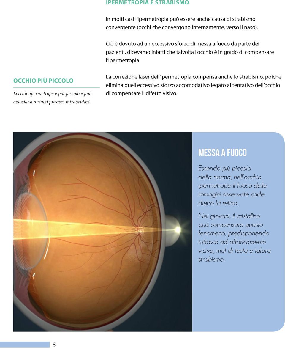 OCCHIO PIÙ PICCOLO L occhio ipermetrope è più piccolo e può associarsi a rialzi pressori intraoculari.