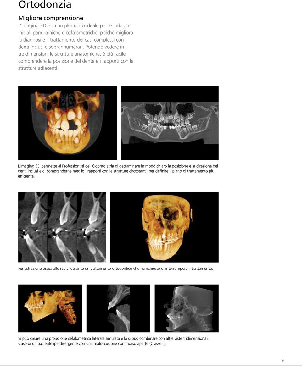 L imaging 3D permette ai Professionisti dell Odontoiatria di determinare in modo chiaro la posizione e la direzione dei denti inclusi e di comprenderne meglio i rapporti con le strutture circostanti,