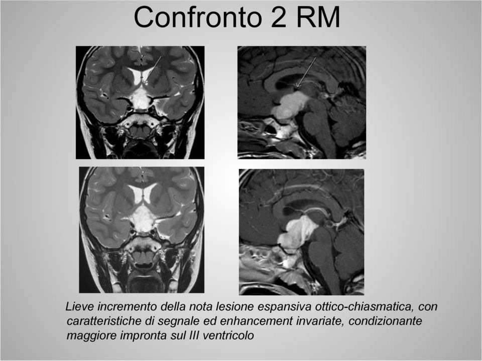 caratteristiche di segnale ed enhancement