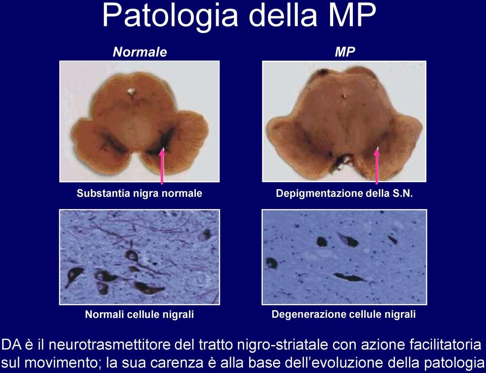 Normali cellule nigrali Degenerazione cellule nigrali DA è il