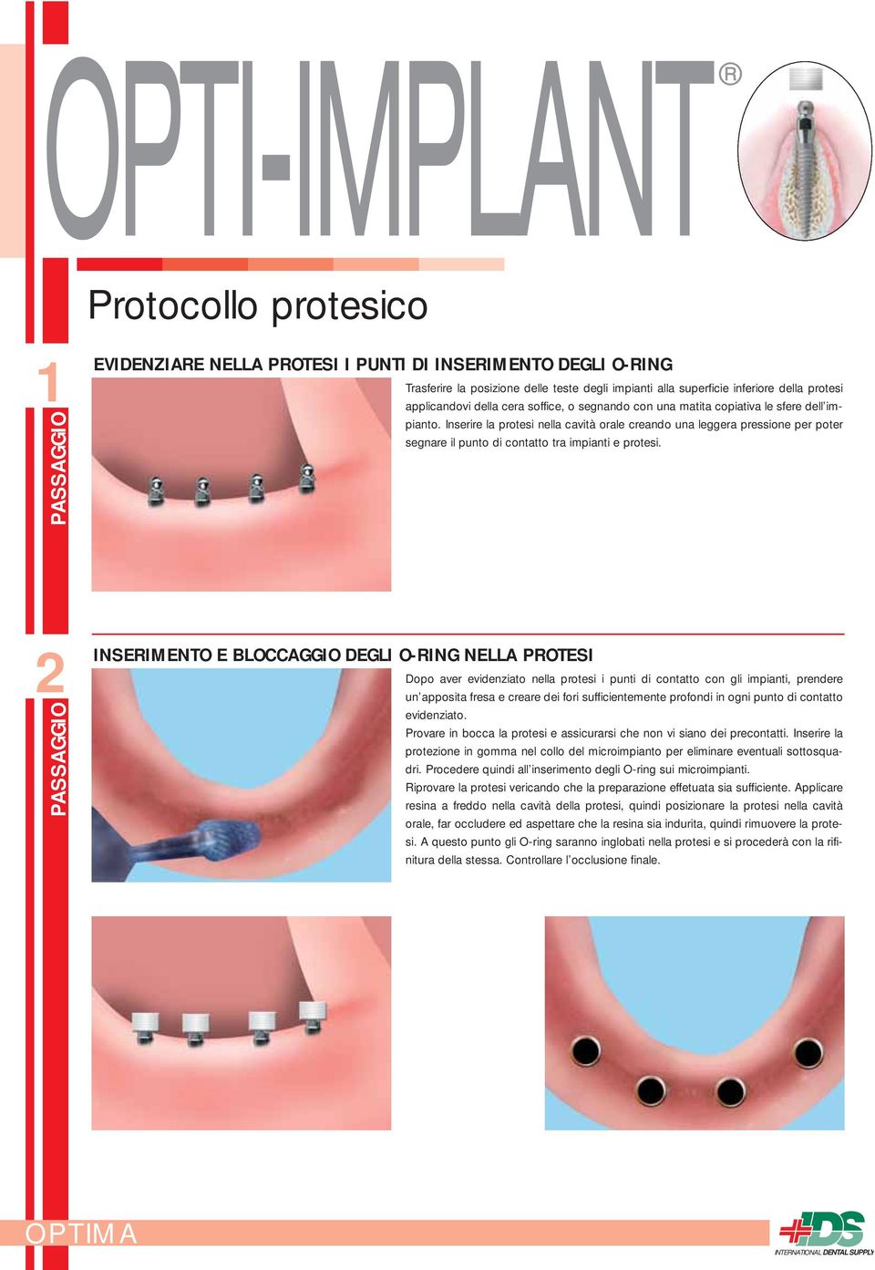 2 INSERIMENTO E BLOCCAGGIO DEGLI O-RING NELLA PROTESI Dopo aver evidenziato nella protesi i punti di contatto con gli impianti, prendere un apposita fresa e creare dei fori sufficientemente profondi