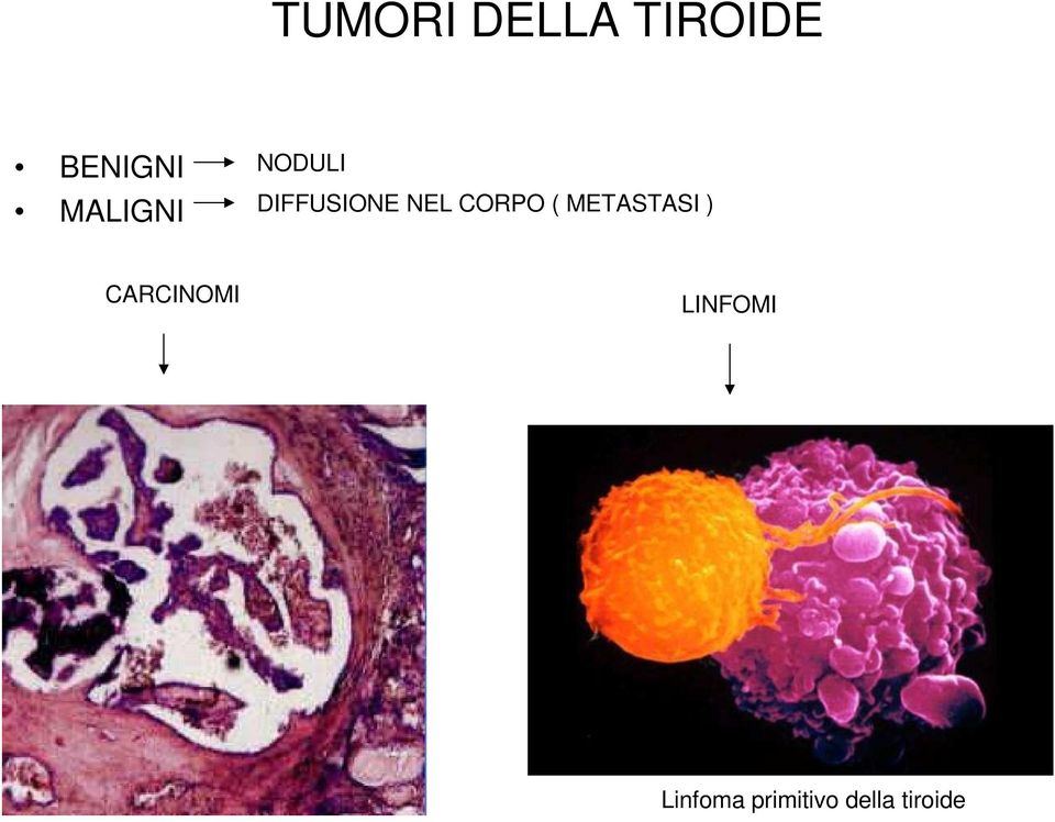 CORPO ( METASTASI ) CARCINOMI