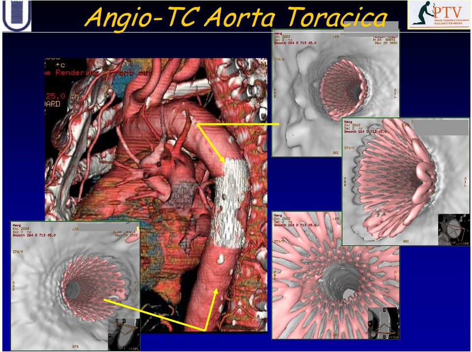 Toracica