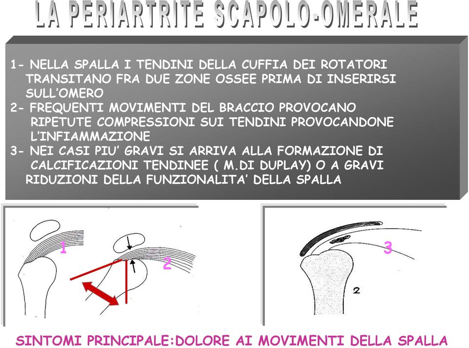 INFIAMMAZIONE 3- NEI CASI PIU GRAVI SI ARRIVA ALLA FORMAZIONE DI CALCIFICAZIONI TENDINEE ( M.