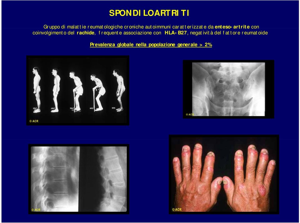 del rachide, frequente associazione con HLA-B27, negatività del