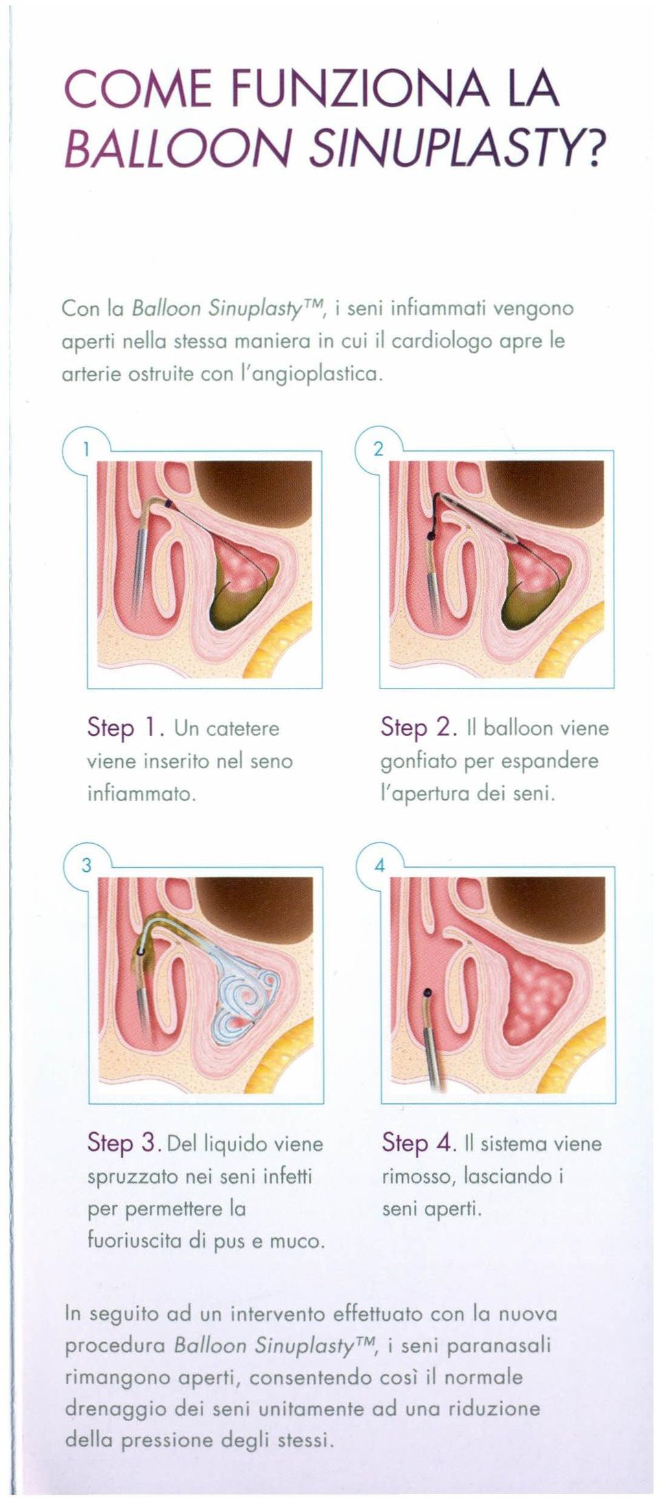 Un catetere viene inserito nel seno infiammato. Step 2. Il balloon viene gonfiato per espandere l'apertura dei seni. Step 3.