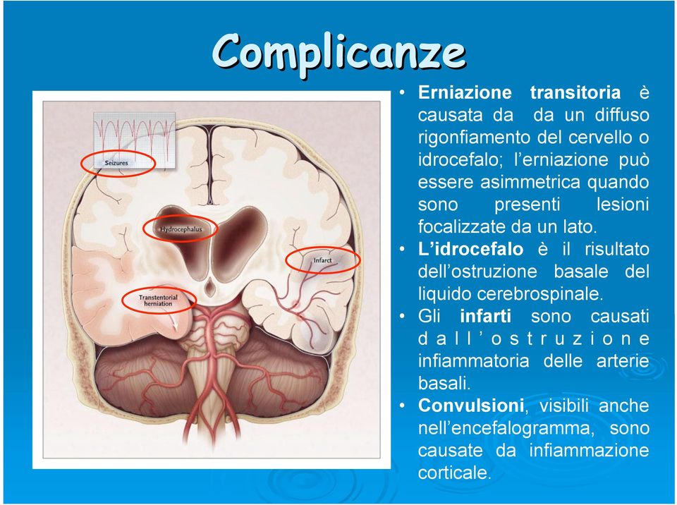 L idrocefalo è il risultato dell ostruzione basale del liquido cerebrospinale.