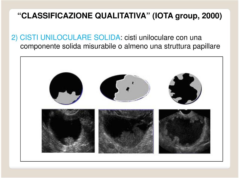 uniloculare con una componente solida