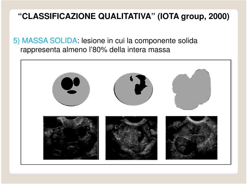 lesione in cui la componente solida