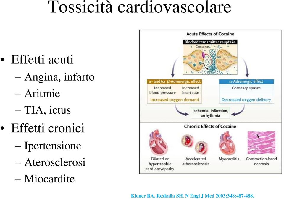 cronici Ipertensione Aterosclerosi Miocardite