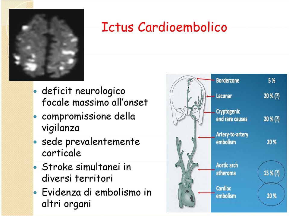 sede prevalentemente corticale Stroke simultanei in