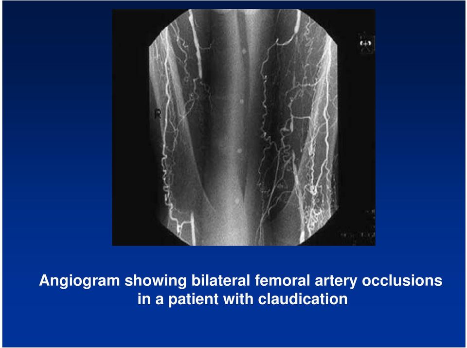 artery occlusions in
