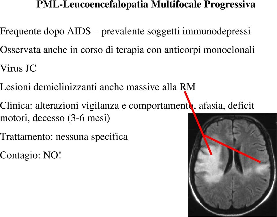 Lesioni demielinizzanti anche massive alla RM Clinica: alterazioni vigilanza e