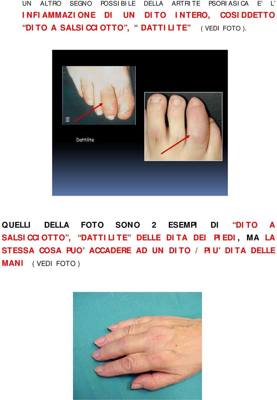 QUELLI DELLA FOTO SONO 2 ESEMPI DI DITO A SALSICCIOTTO, DATTILITE DELLE DITA