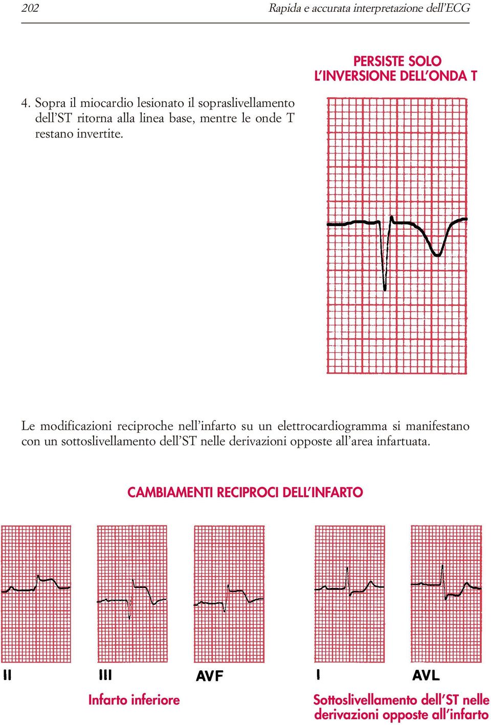 PERSISTE SOLO L INVERSIONE DELL ONDA T Le modificazioni reciproche nell infarto su un elettrocardiogramma si manifestano
