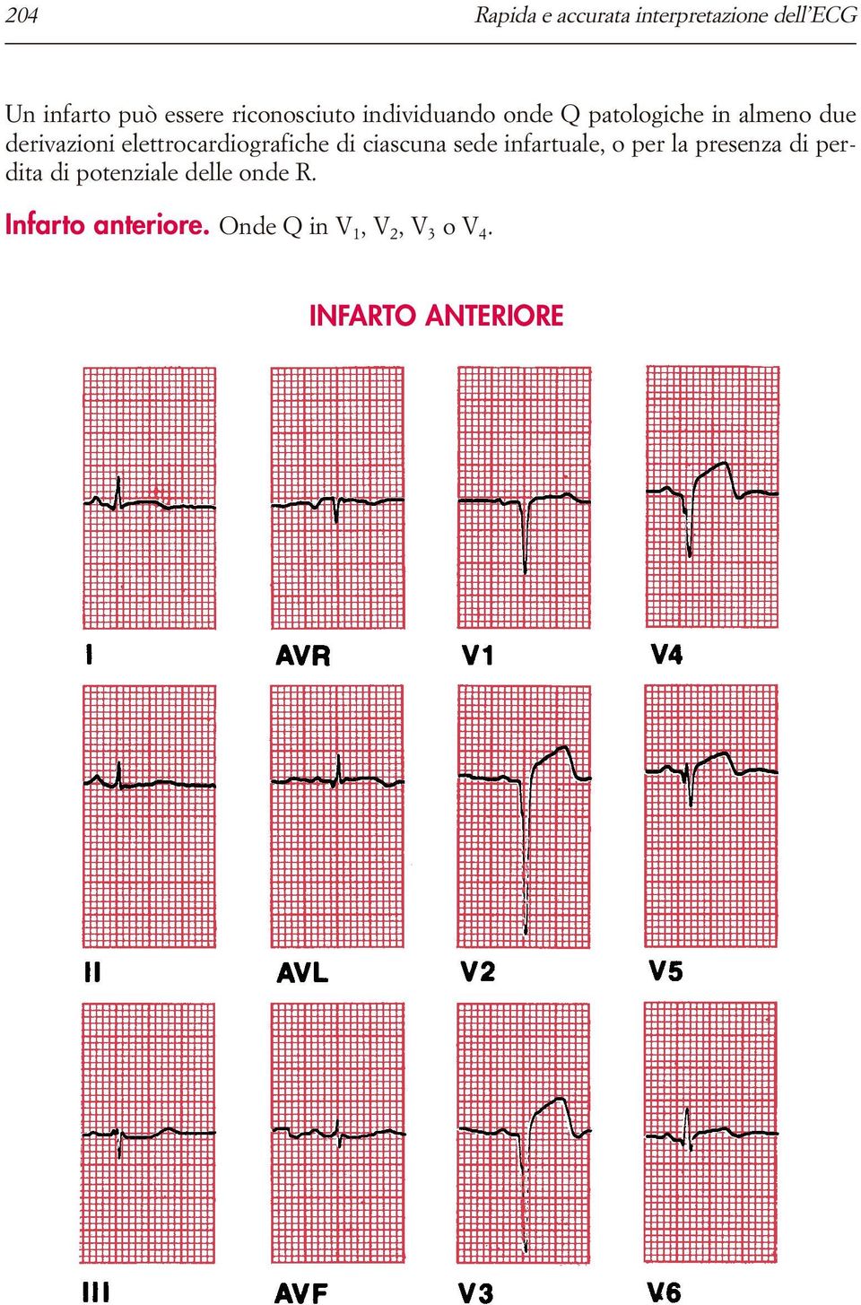elettrocardiografiche di ciascuna sede infartuale, o per la presenza di