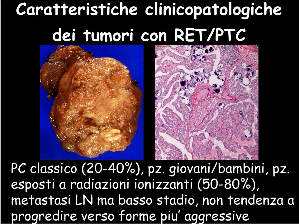 esposti a radiazioni ionizzanti (50-80%), metastasi LN ma