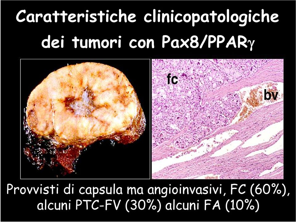 di capsula ma angioinvasivi, FC