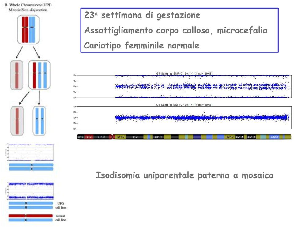 microcefalia Cariotipo femminile