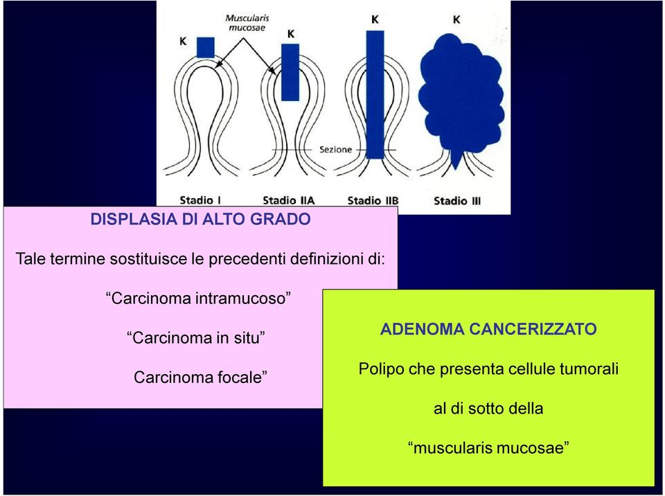 Carcinoma in situ Carcinoma focale ADENOMA CANCERIZZATO