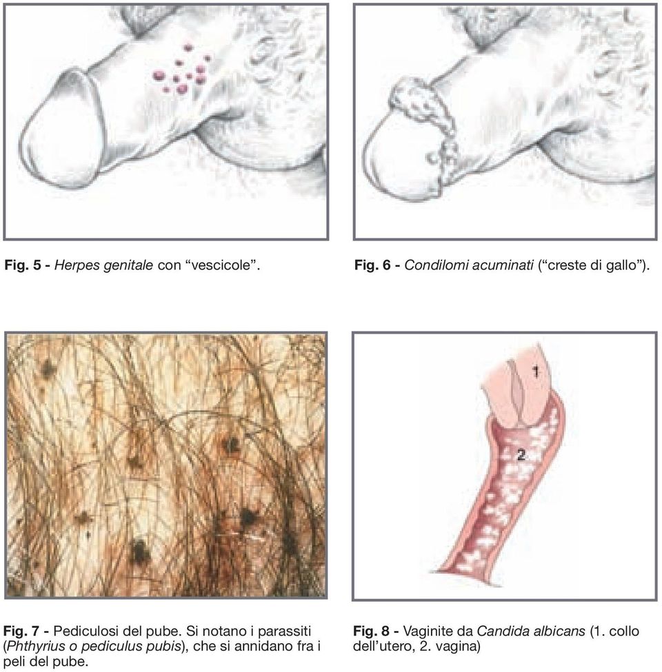 7 - Pediculosi del pube.