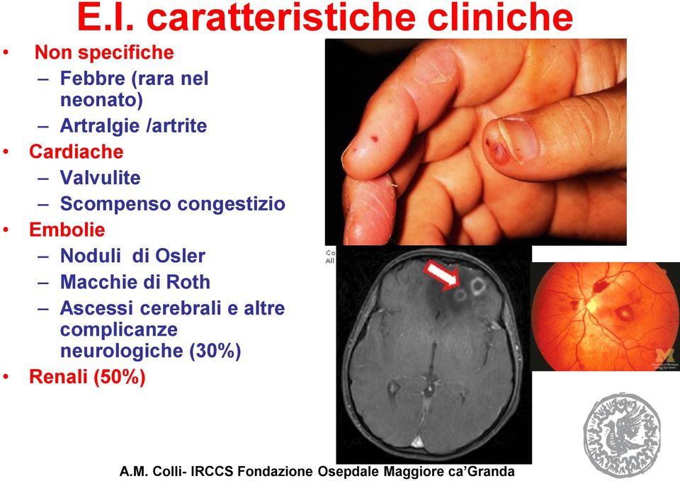 Noduli di Osler Macchie di Roth Ascessi cerebrali e altre complicanze