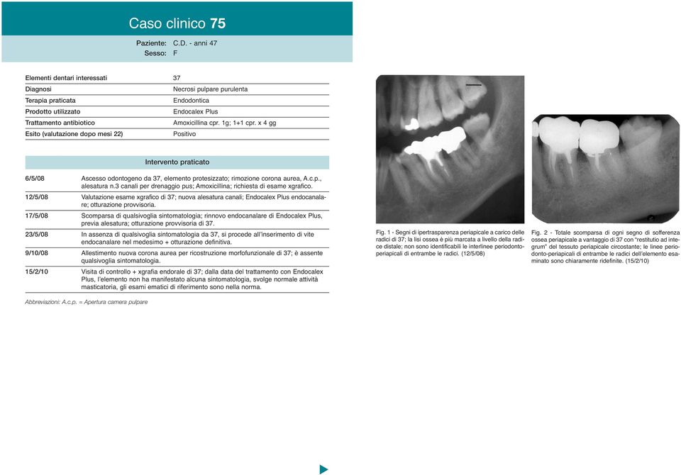 3 canali per drenaggio pus; Amoxicillina; richiesta di esame xgrafico. 12/5/08 Valutazione esame xgrafico di 37; nuova alesatura canali; endocanalare; otturazione provvisoria.