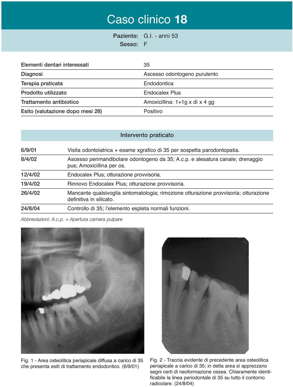 parodontopatia. 8/4/02 Ascesso perimandibolare odontogeno da 35; A.c.p. e alesatura canale; drenaggio pus; Amoxicillina per os. 12/4/02 ; otturazione provvisoria.