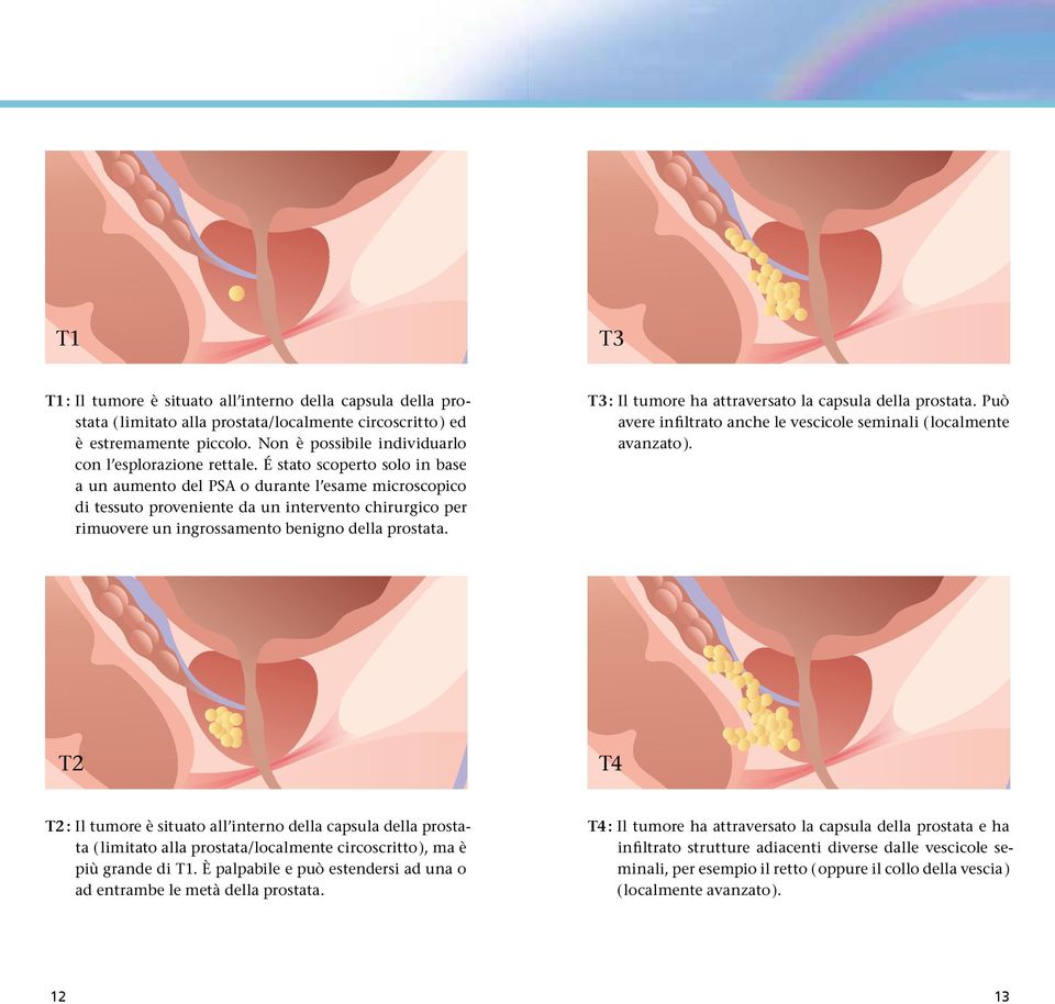 É stato scoperto solo in base a un aumento del PSA o durante l esame microscopico di tessuto proveniente da un intervento chirurgico per rimuovere un ingrossamento benigno della prostata.