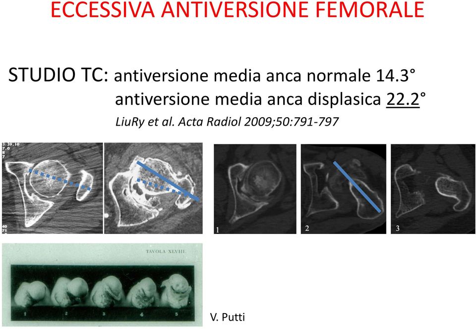 3 antiversione media anca displasica 22.