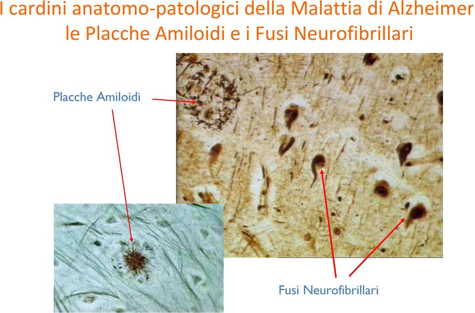 Amiloidi e i Fusi Neurofibrillari