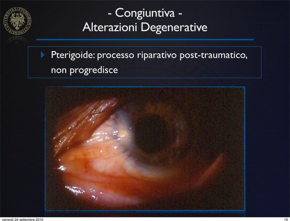 Pterigoide: processo