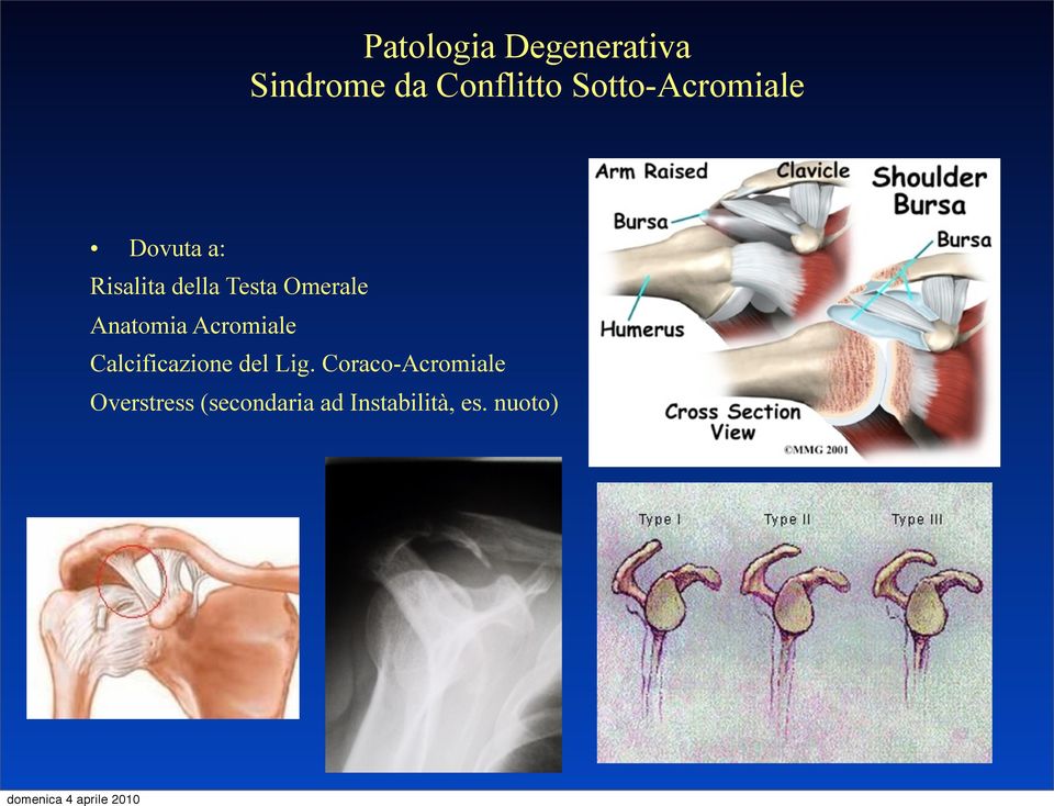 Omerale Anatomia Acromiale Calcificazione del Lig.