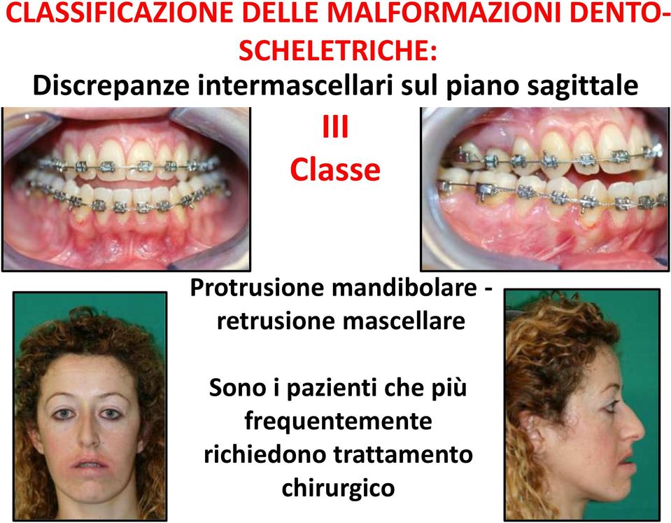 Protrusione mandibolare - retrusione mascellare Sono i