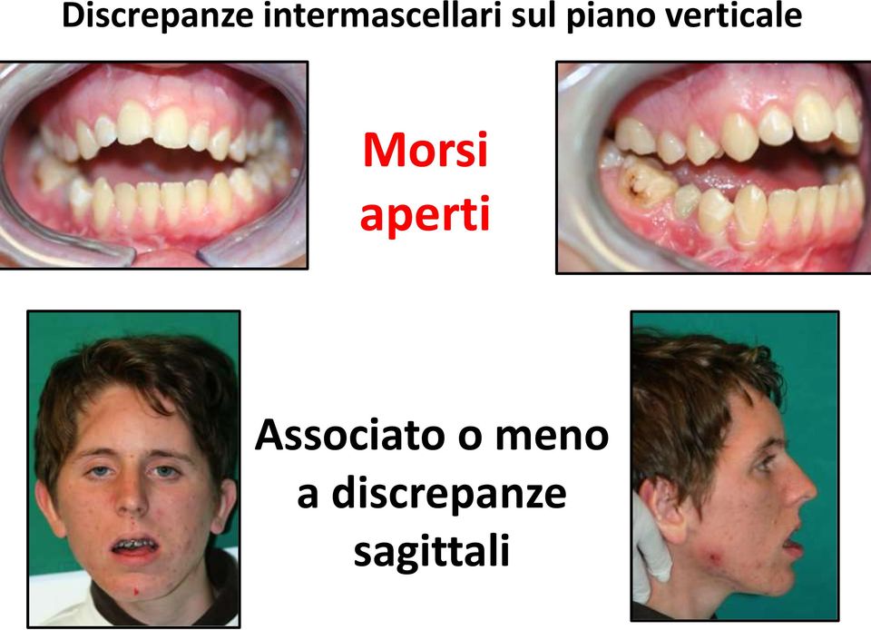 verticale Morsi aperti