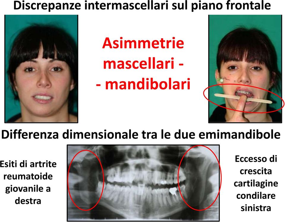 due emimandibole Esiti di artrite reumatoide giovanile a