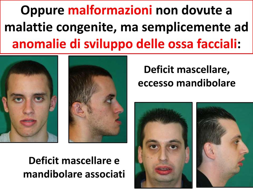 sviluppo delle ossa facciali: Deficit mascellare,