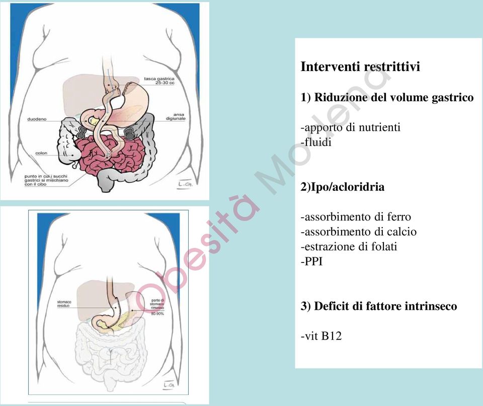 2)Ipo/acloridria -assorbimento di ferro -assorbimento