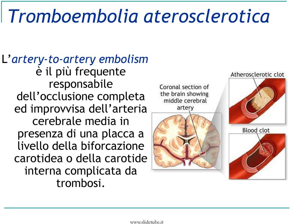 arteria cerebrale media in presenza di una placca a livello della