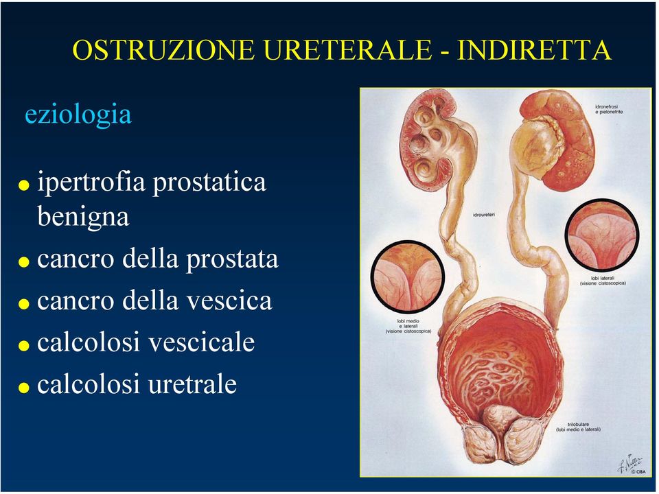 benigna cancro della prostata cancro