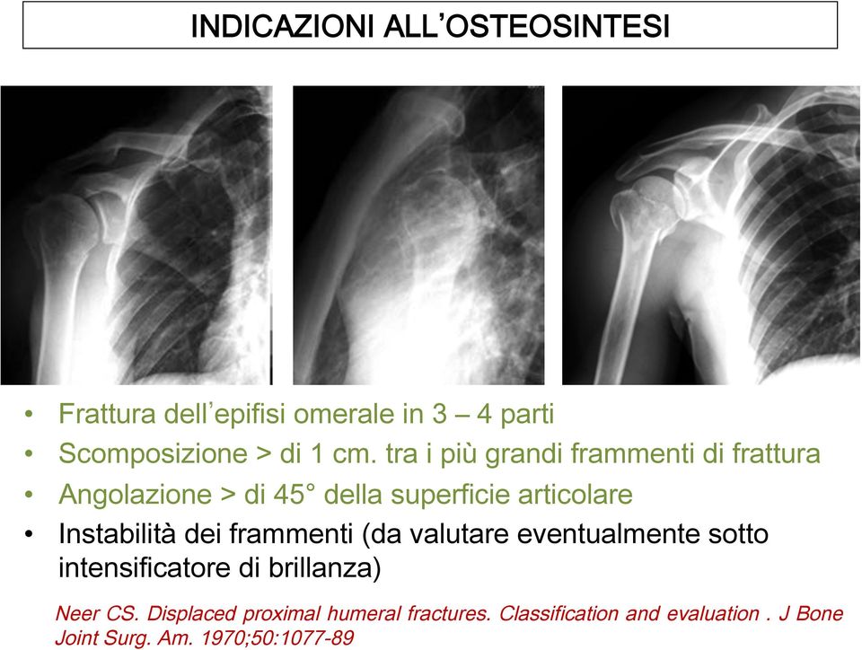 Instabilità dei frammenti (da valutare eventualmente sotto intensificatore di brillanza) Neer CS.