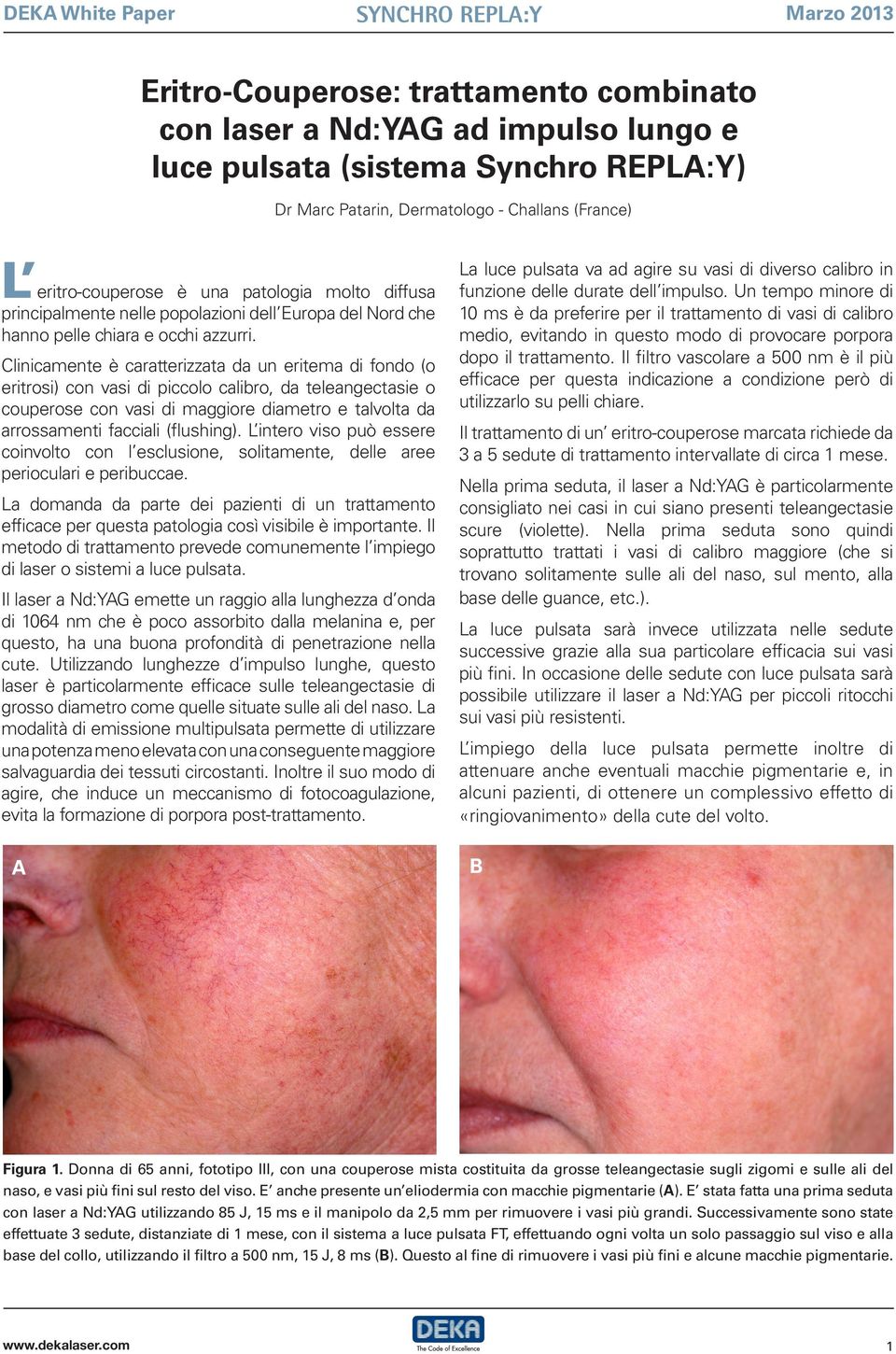 Clinicamente è caratterizzata da un eritema di fondo (o eritrosi) con vasi di piccolo calibro, da teleangectasie o couperose con vasi di maggiore diametro e talvolta da arrossamenti facciali